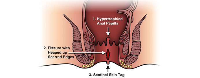 Best Laser Treatment For Anal Fissure in Thane