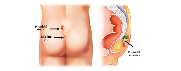 Best Endoscopic And Laser Treatment For Pilonidal Sinus in Thane