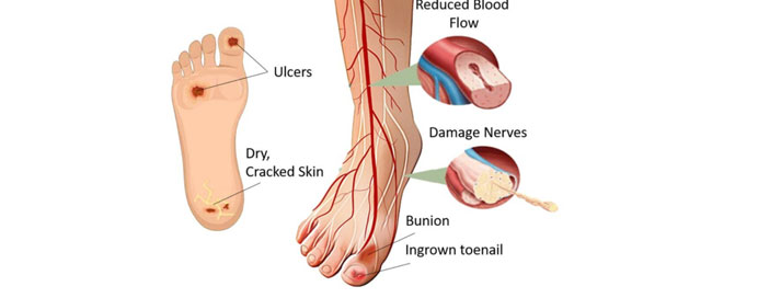 Best Doctor For Diabetic Foot Treatment in Thane