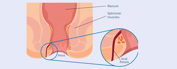 Best Laser Endoscopic And Laser Treatment For Fistula in Thane